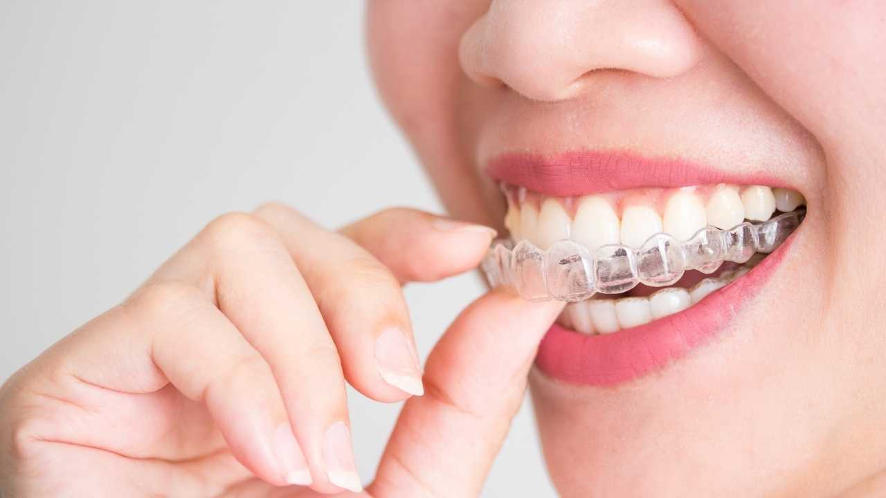 Clear Aligners